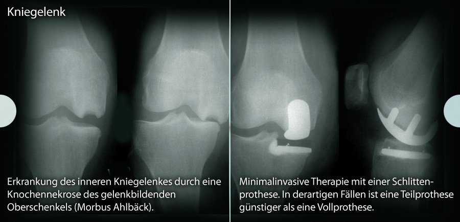 Beratung und Therapie zum Thema Bei fortgeschrittenem Gelenkverschleiß von... Gelenkprothese Gelenkprothese